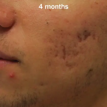 JH Morpheus8 2B Sequence4month7years