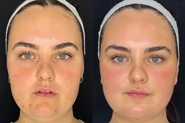 Sculpting Confidence: Molly's FaceTite Journey with Miss Natasha Berridge at The Door W4