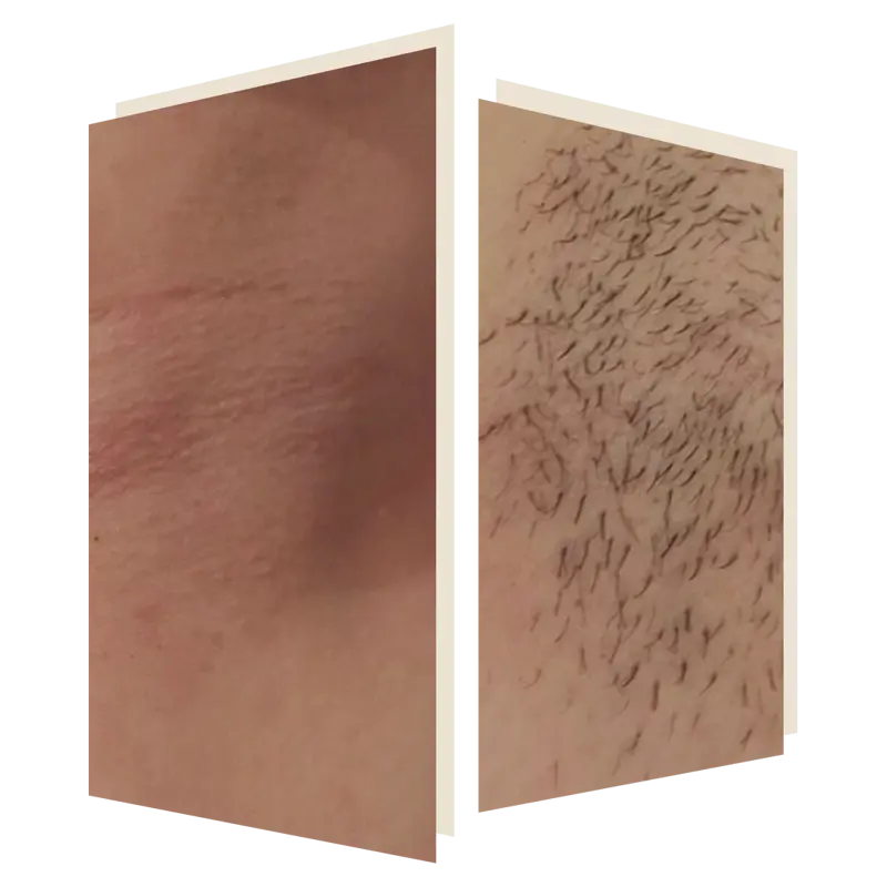 laser hair removal at the door w4