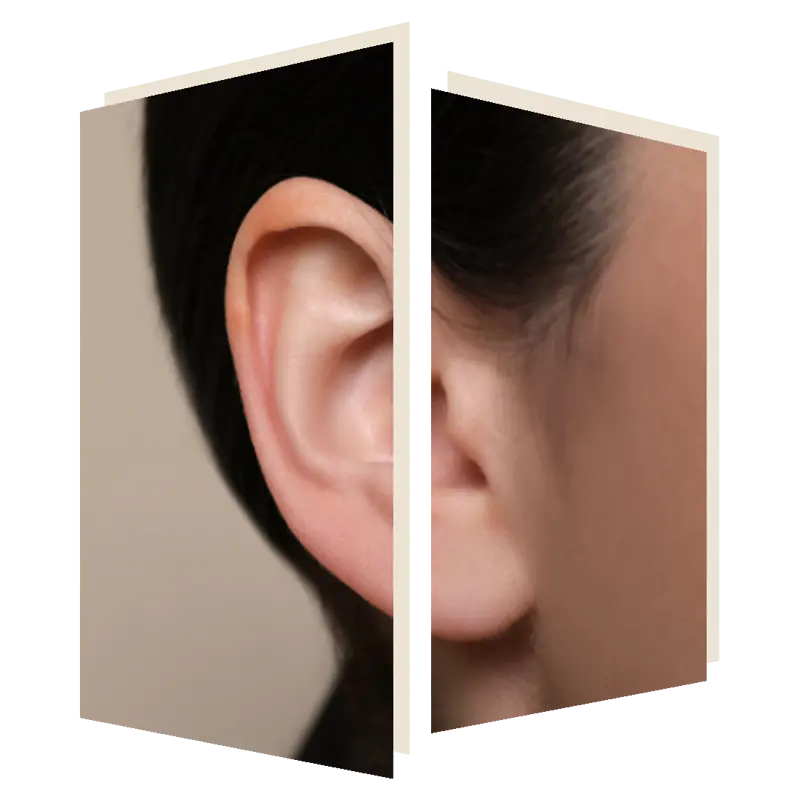 earlobe reconstruction