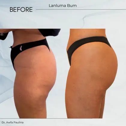 Lanluma Bum Augmentation
