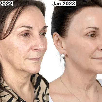 FINAL Before And After Dr Judy Todd Feb 22 To Jan 23 MR