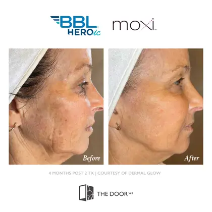 202605 Before and Afters, Sciton BBL Moxi-16.jpg (1)