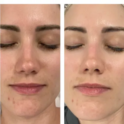 Before And After Infusion Lab Facial 2 (1)
