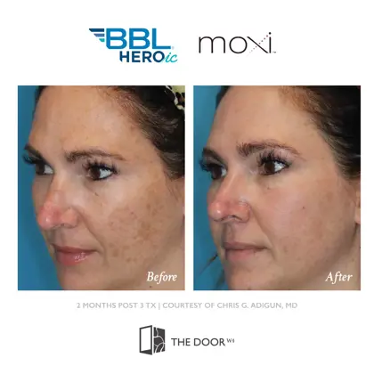 202605 Before and Afters, Sciton BBL Moxi-18.jpg (1)