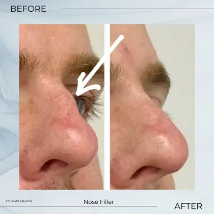 Nose Filler