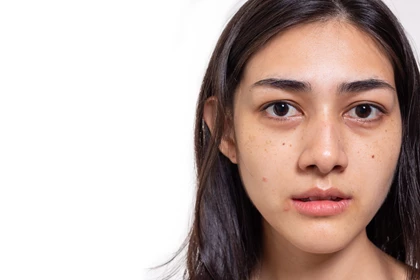Dehydrated Skin