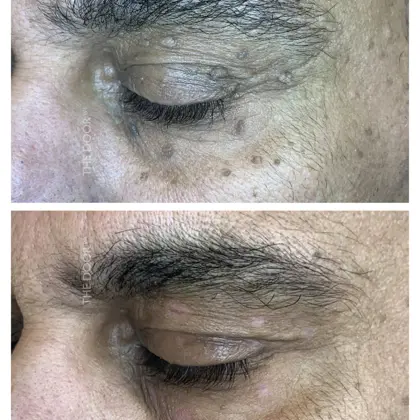 Skin Tag Removal Before And After 04 Copy