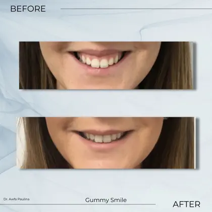 Gummy Smile