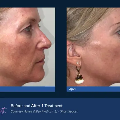 Agejet B&A Hayes Valley Medical Agejet Smooth Female 2