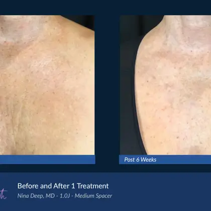 BA Agejet Smooth Femaie Deep Chest