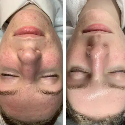 LUNCTIME PEEL Before And After