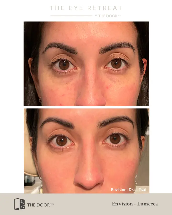 En Vision Ipl Lumecca-I Intense Pulsed Light (IPL) Therapy — The Door W4