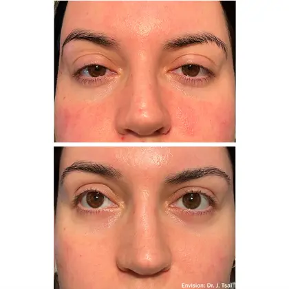 Envision Lumecca And Forma Before And After 02 2 (1)