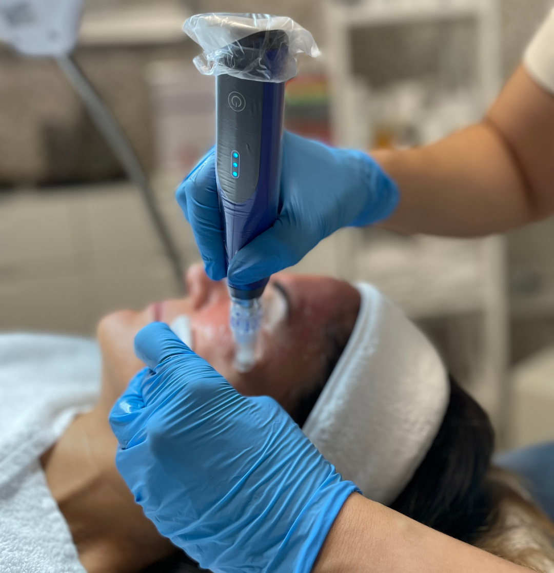 1. SkinPen® Microneedling