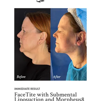 web version - 202603 Before and After, FT, M8 and Liposuction.jpg