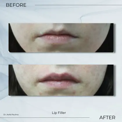 Lip Filler