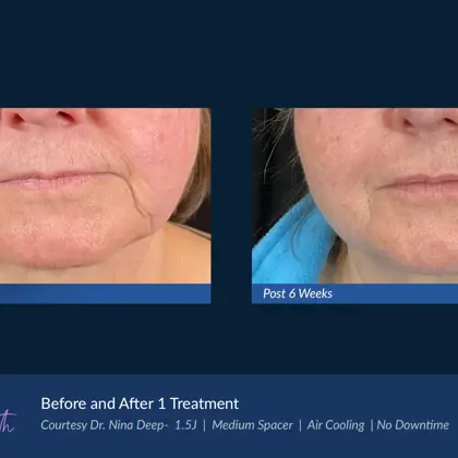 BA Agejet Smooth Female Lips Deep