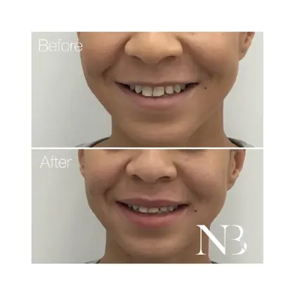 Before & Afters Dr Natasha 7