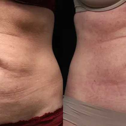 MC M8body 1A Abdomen