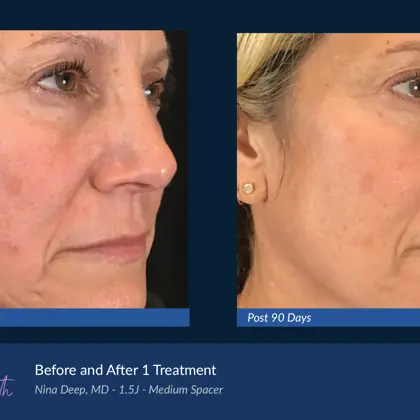 BA Agejet Smooth Femaie Deep