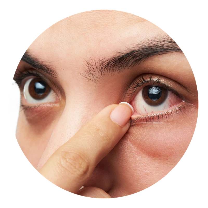 dry eyes treatment