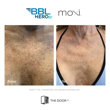 202605 Before and Afters, Sciton BBL Moxi-14.jpg (1)