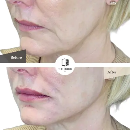 Jawline Fillers Before And Afters Copy 2