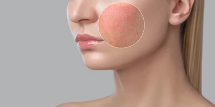 Dye Vascular Lesions (DYE VL)