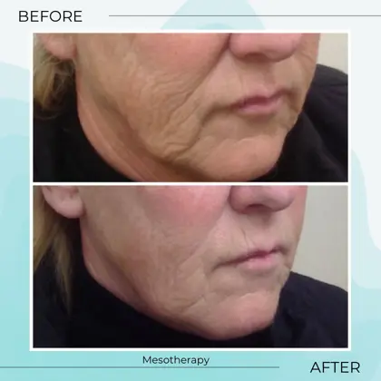 Mesotherapy