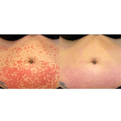Before And After Red 6 Sessions 2 Weeks