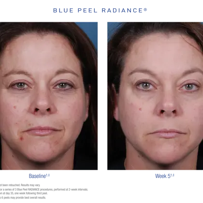 US BPR Before After 1 Small