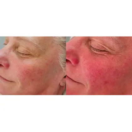 Before And After NIR 1 Session 1 Day Copy