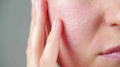 Enlarged Pores
