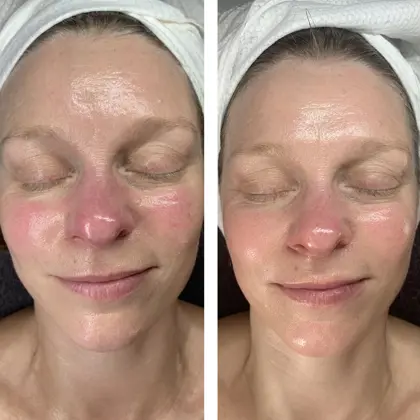 Fire And Ice Nic Redness Before And After