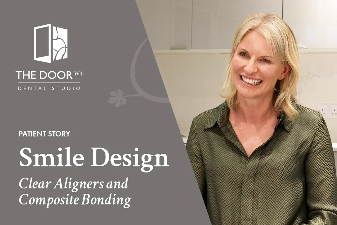 Helen's Smile Transformation: Clear Aligners and Composite Bonding with Dr. Julia Coelho at The Door W4 Dental Studio